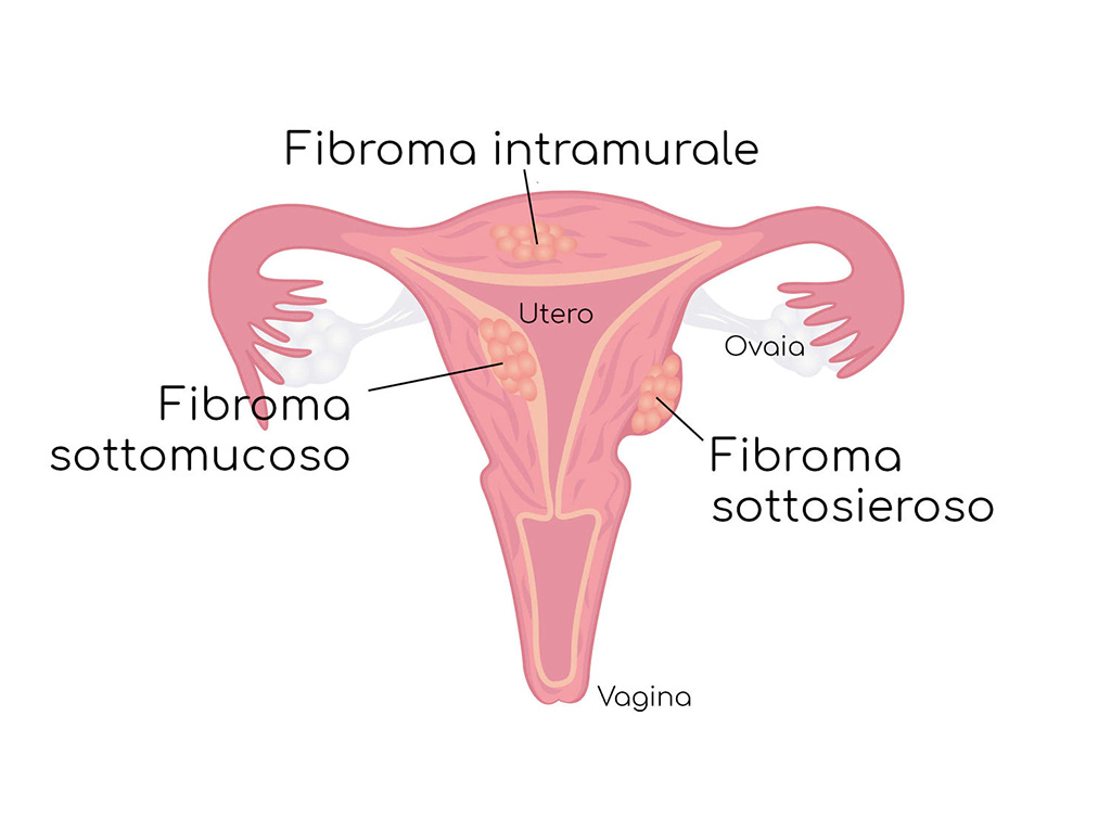 tipologie di fibromi